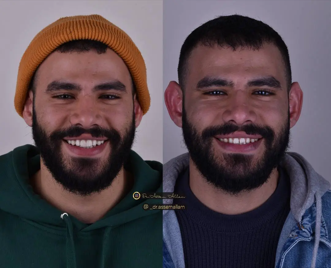 Momen Before and After